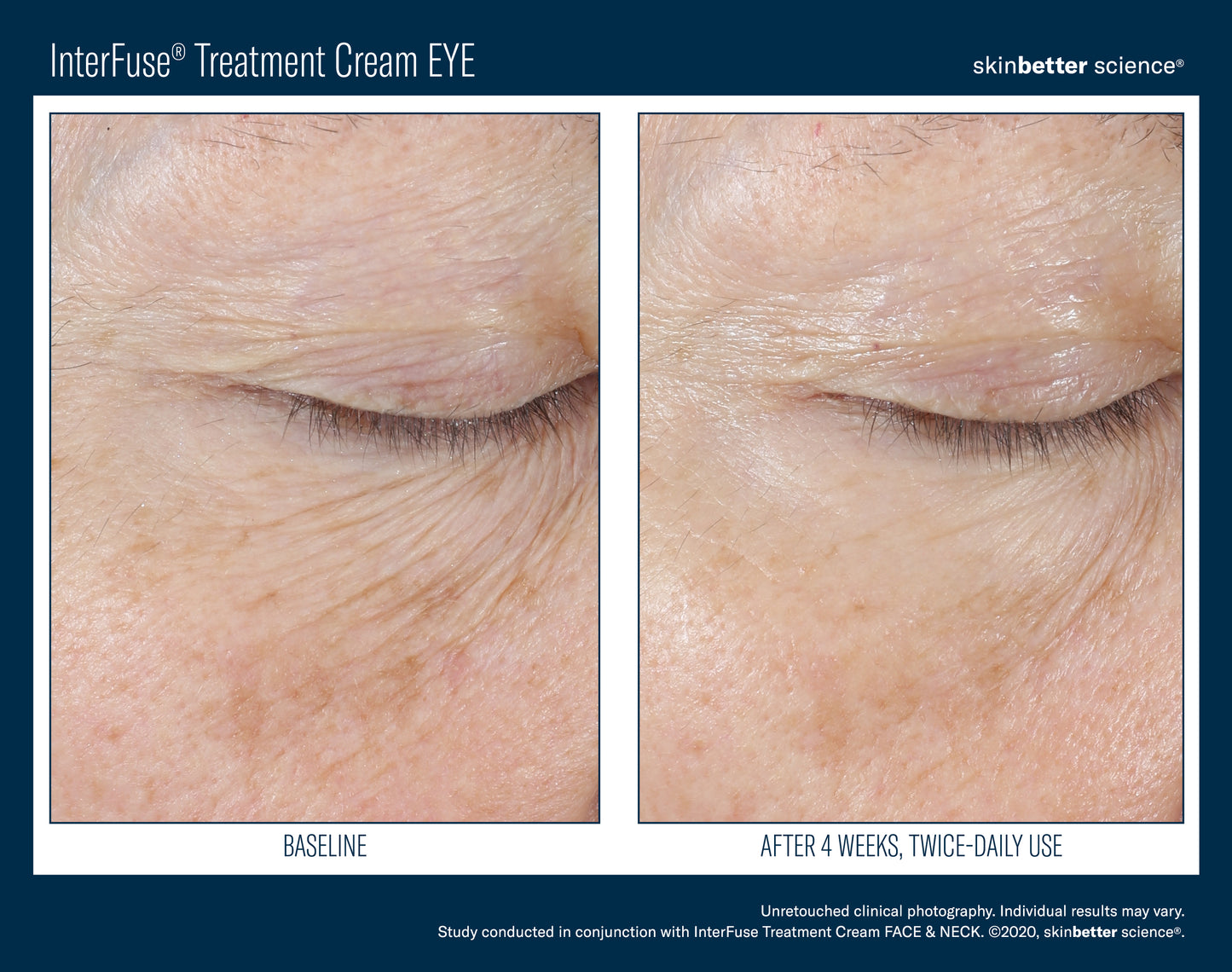 Skinbetter Science® Interfuse® Treatment Cream EYE