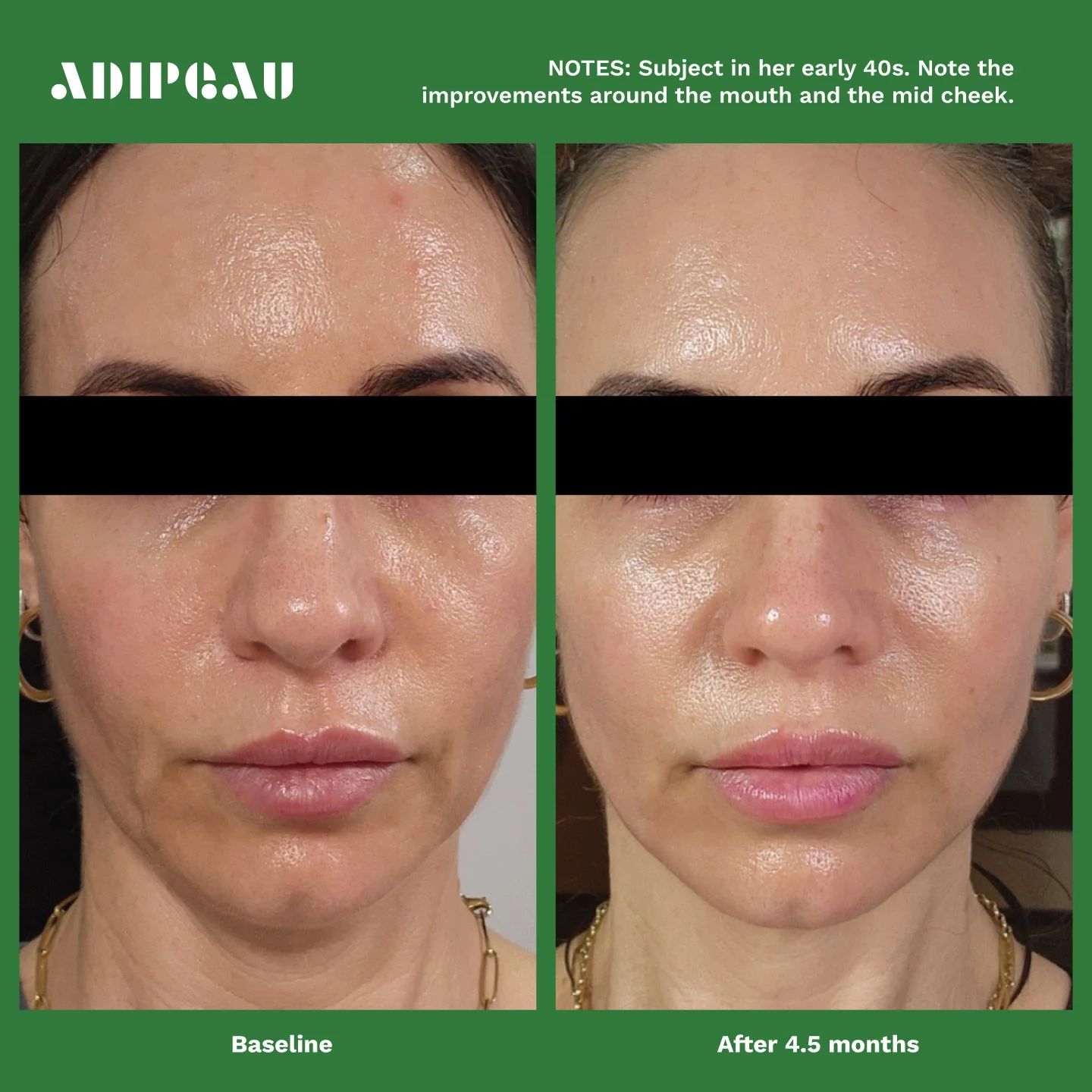 ADIPEAU Volume Cream 60 ml