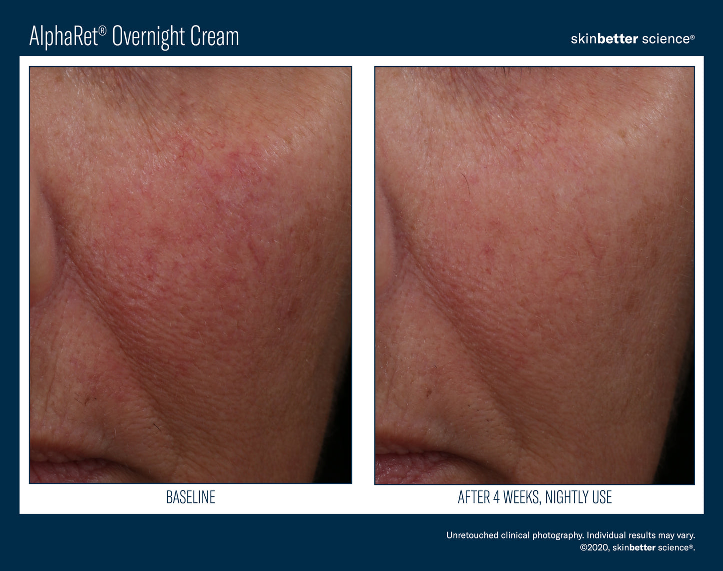 Skinbetter Science® Alpharet® Overnight Cream