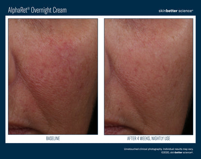 Skinbetter Science® Alpharet® Overnight Cream