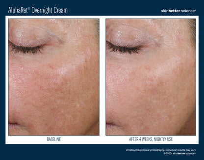 Skinbetter Science® Alpharet® Overnight Cream
