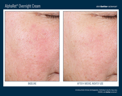 Skinbetter Science® Alpharet® Overnight Cream