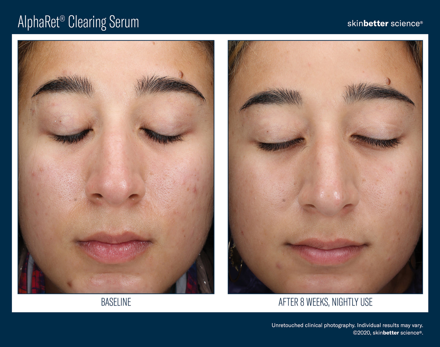 Skinbetter Science® Alpharet® Clearing Serum