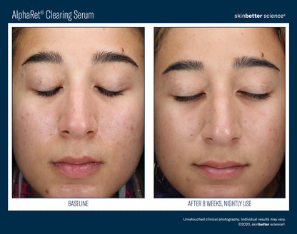 Skinbetter Science® Alpharet® Clearing Serum