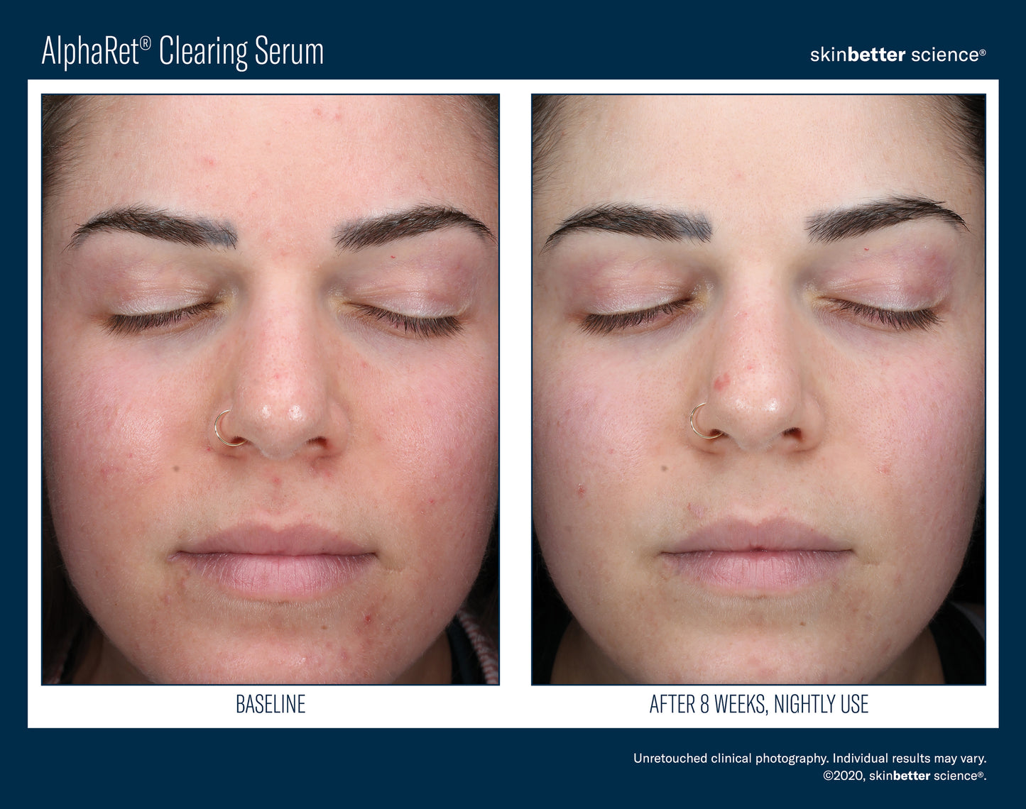 Skinbetter Science® Alpharet® Clearing Serum