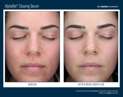 Skinbetter Science® Alpharet® Clearing Serum