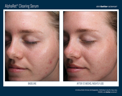 Skinbetter Science® Alpharet® Clearing Serum