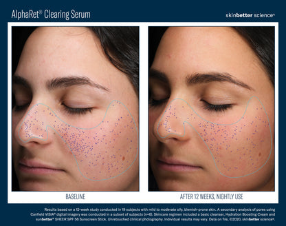 Skinbetter Science® Alpharet® Clearing Serum