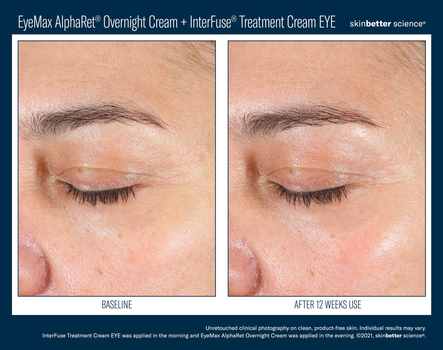 Skinbetter Science® EyeMax™ AlphaRet® Overnight EYE Cream