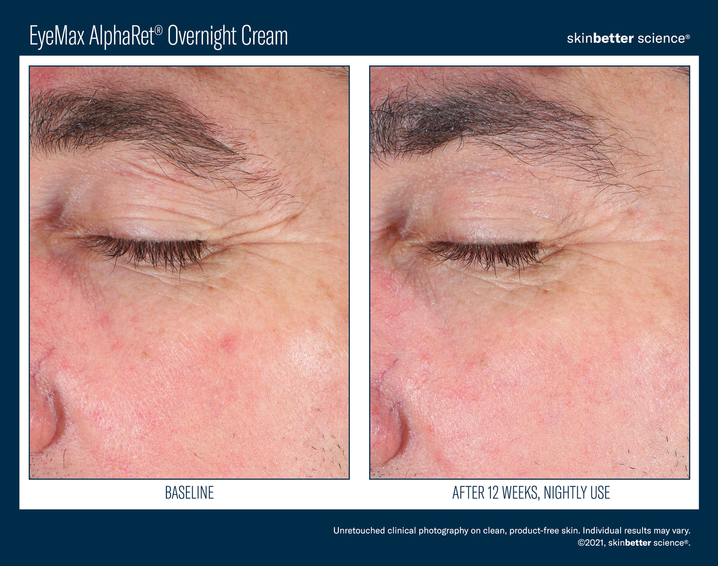 Skinbetter Science® EyeMax™ AlphaRet® Overnight EYE Cream