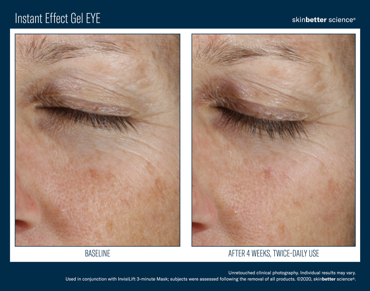 Skinbetter Science® Instant Effect Gel EYE