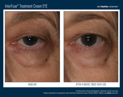 Skinbetter Science® Interfuse® Treatment Cream EYE