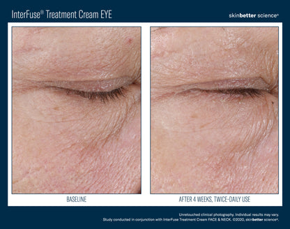 Skinbetter Science® Interfuse® Treatment Cream EYE