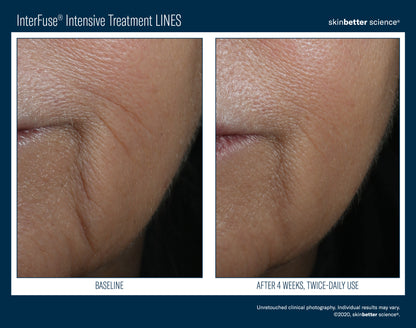 Skinbetter Science® Interfuse® Intensive Treatment LINES