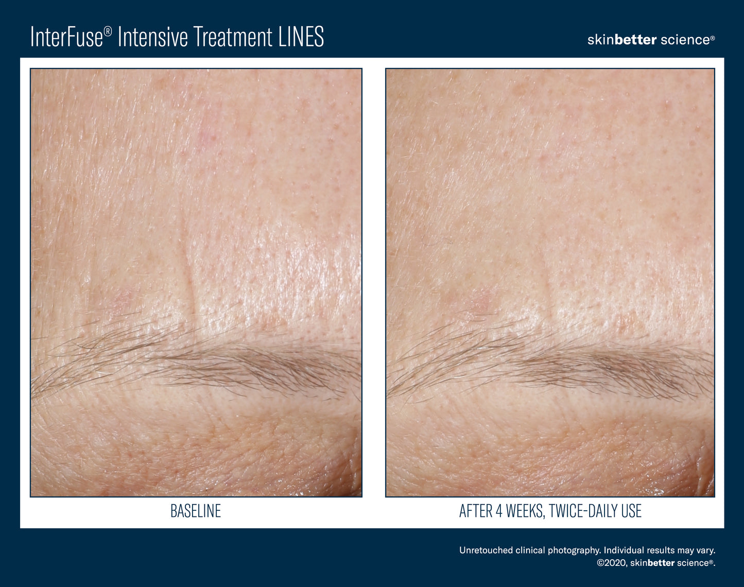 Skinbetter Science® Interfuse® Intensive Treatment LINES