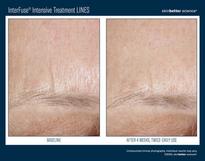 Skinbetter Science® Interfuse® Intensive Treatment LINES