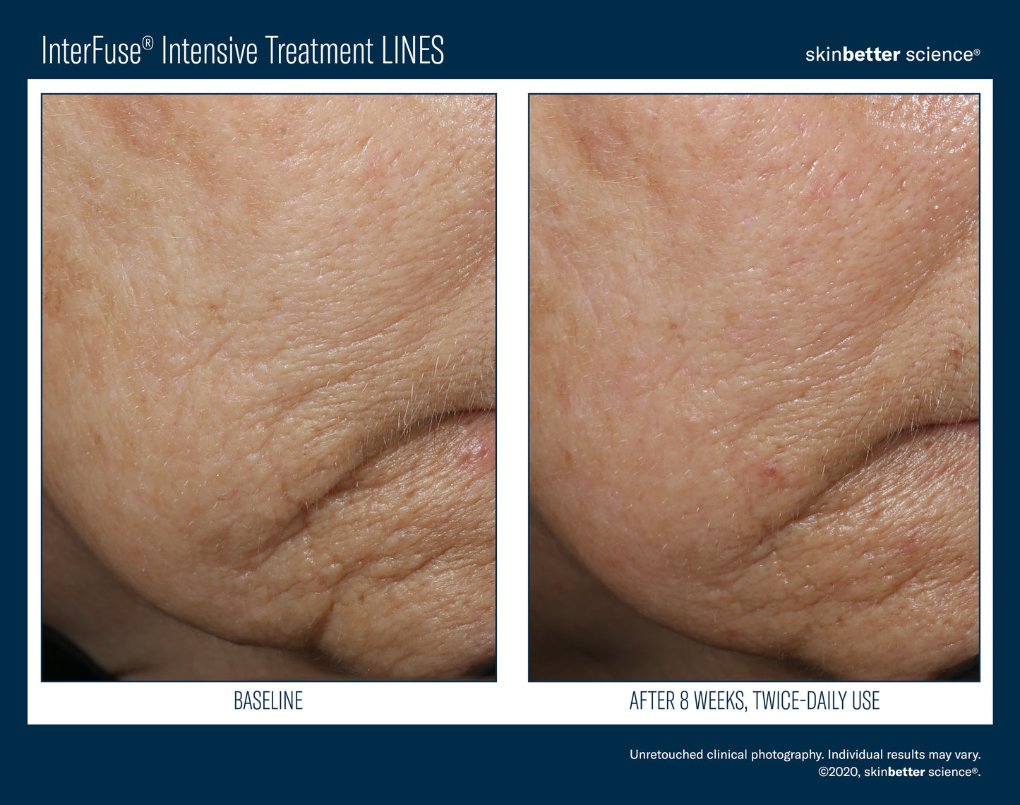 Skinbetter Science® Interfuse® Intensive Treatment LINES