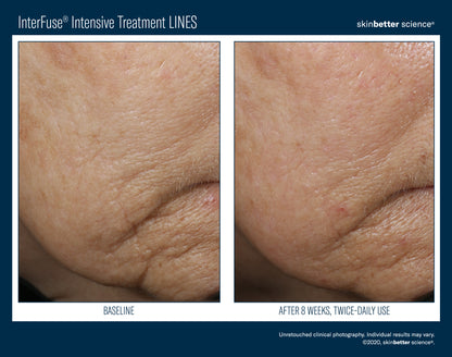 Skinbetter Science® Interfuse® Intensive Treatment LINES