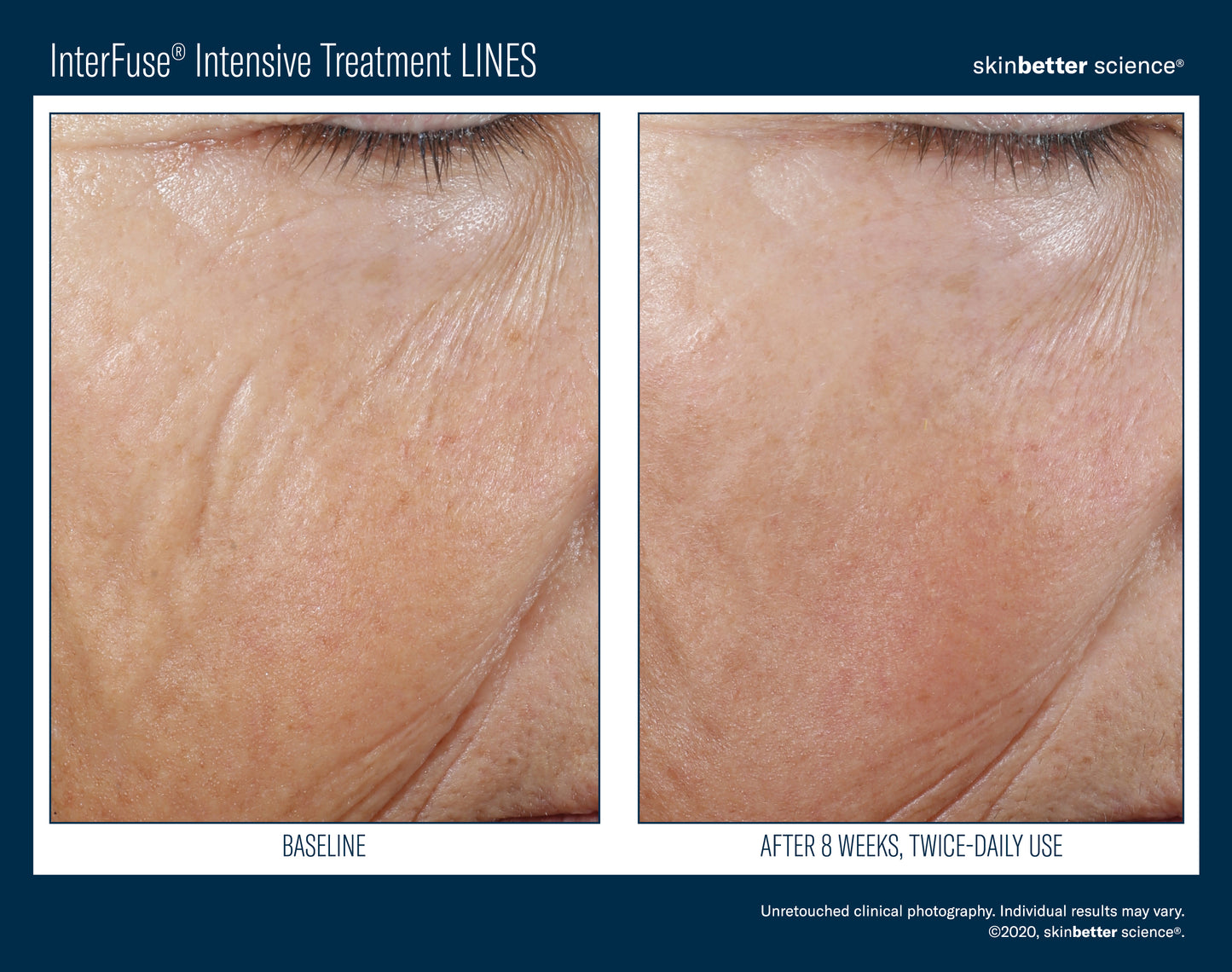 Skinbetter Science® Interfuse® Intensive Treatment LINES
