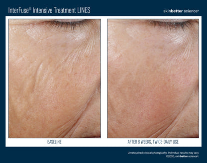 Skinbetter Science® Interfuse® Intensive Treatment LINES