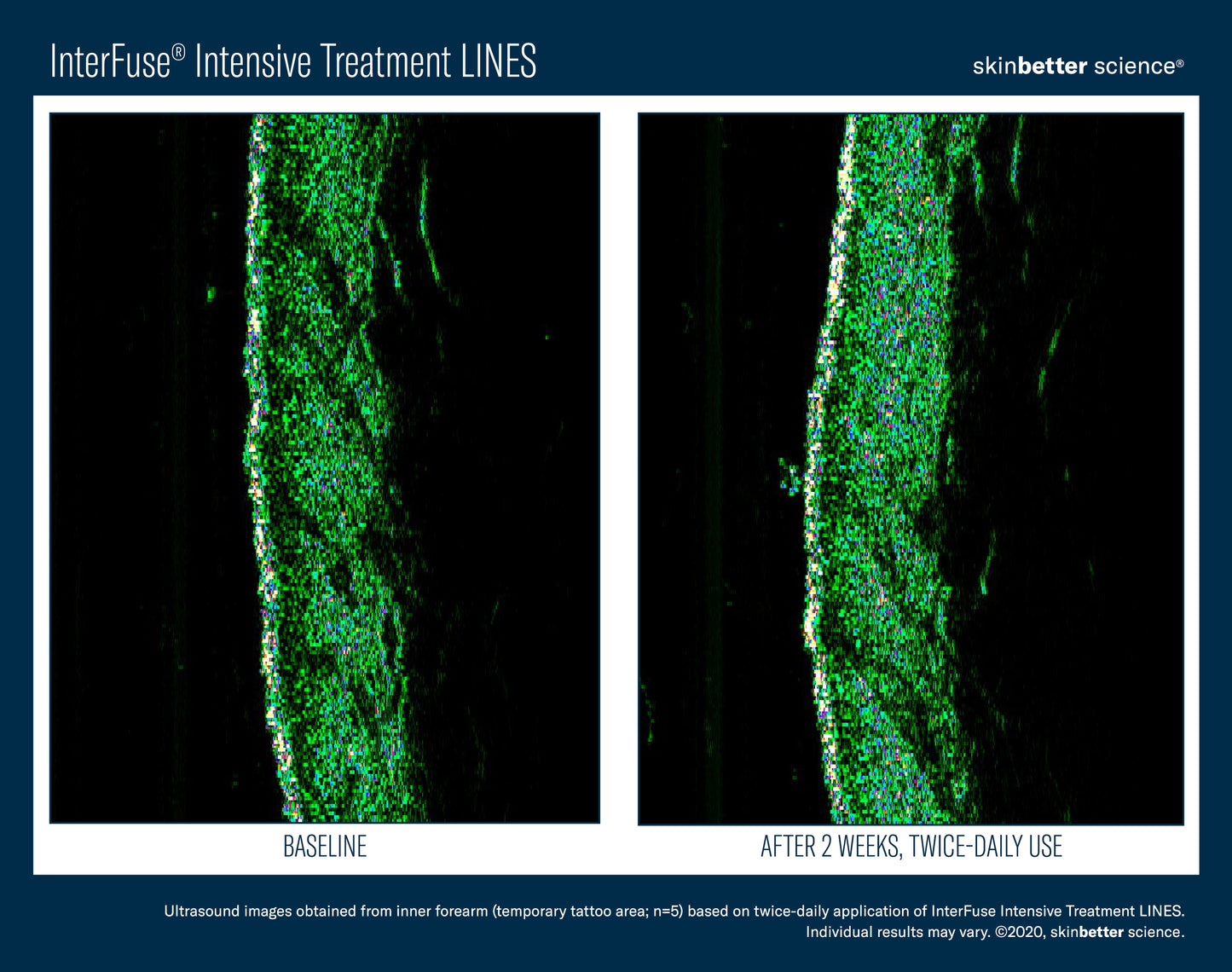 Skinbetter Science® Interfuse® Intensive Treatment LINES