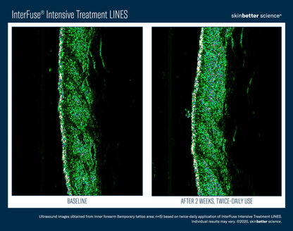 Skinbetter Science® Interfuse® Intensive Treatment LINES