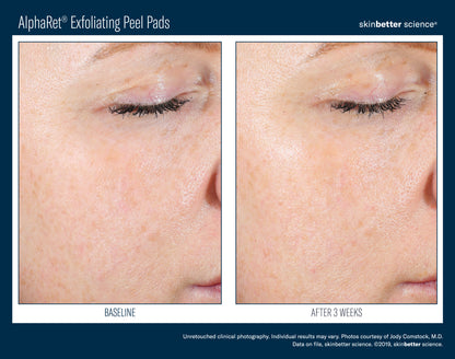 Skinbetter Science® Alpharet® Exfoliating Peel Pads