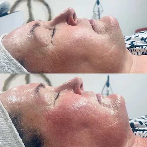 Radio Frequency Lower Face Jowels Combined