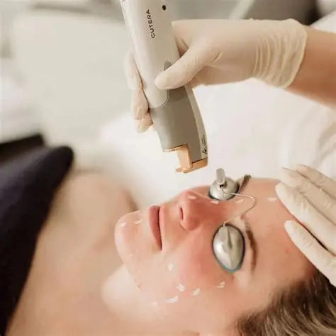 Micro needling and laser genesis