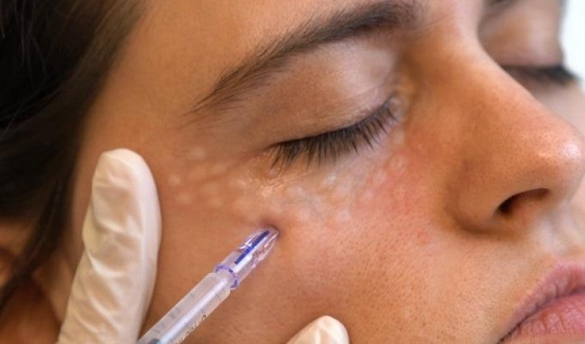 Mesotherapy Eyes