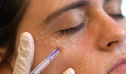 Mesotherapy Eyes