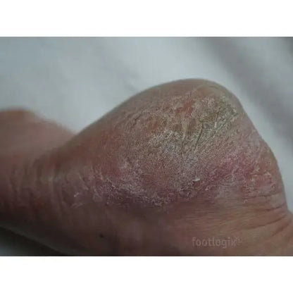 Footlogix DD Cream Mousse Formula