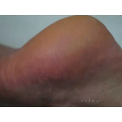 Footlogix DD Cream Mousse Formula